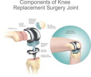 Knee Replacement Surgery