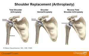 Shoulder Replacement Surgery What to Expect and When It’s Needed