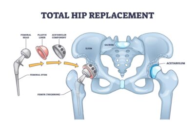 What Is the Newest Technique for Hip Replacement?