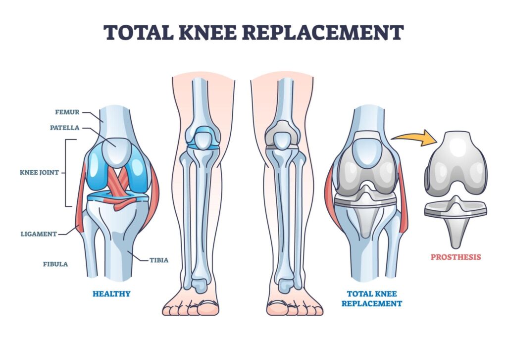 Total Joint Replacements