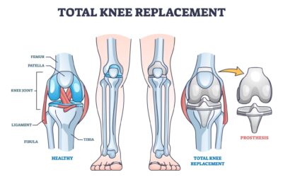 Knee Replacement Surgery: What to Expect
